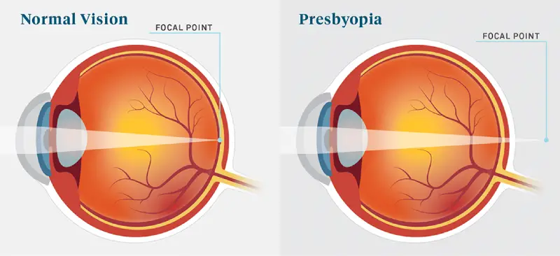 Normal vision and presbyopia