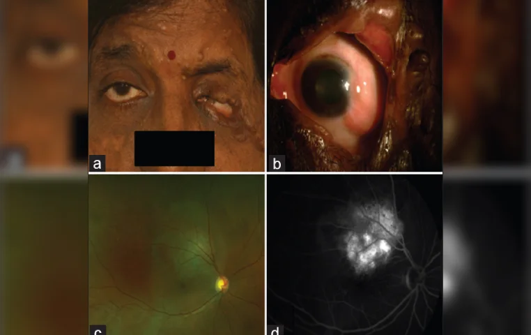 Circumscribed choroidal hemangioma in a case of neurofibromatosis type 1 Circumscribed choroidal hemangioma in a case of neurofibromatosis type 1