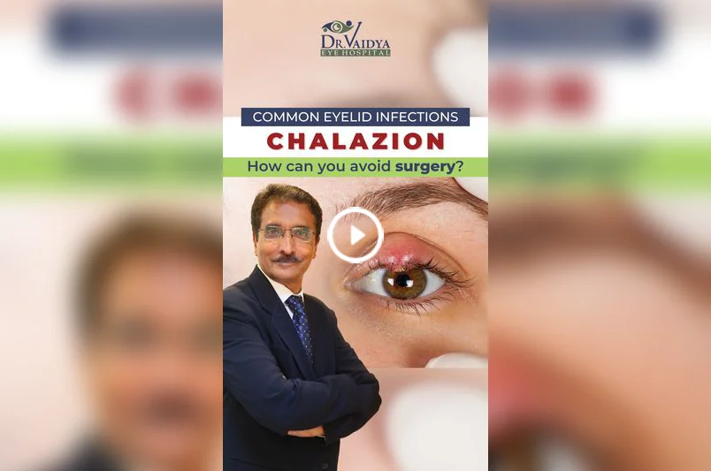 Common Eyelid Infections Chalazion. How can you Avoid Surgery? at Dr
