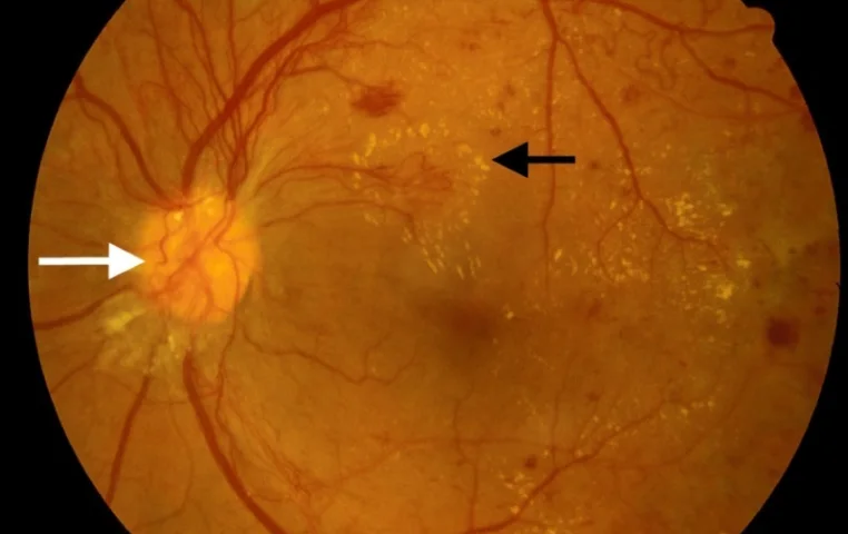 Diabetic Retinopathy Diabetic Retinopathy