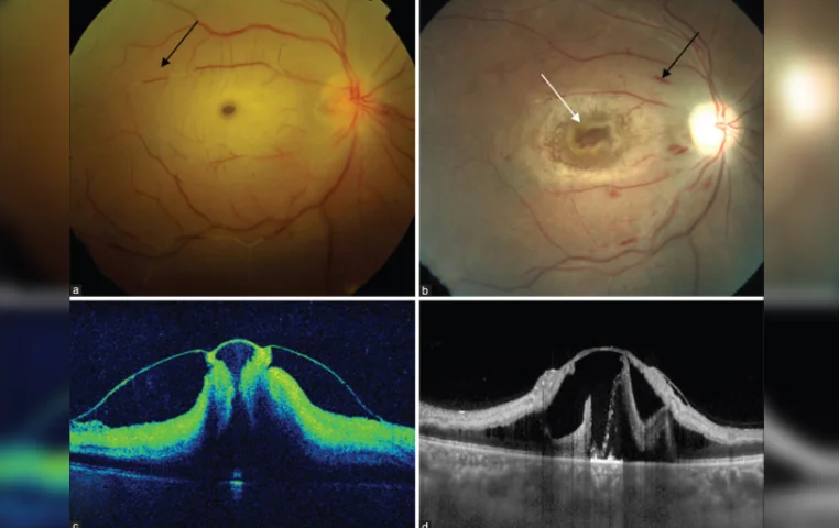 Ischemic macular hole in central retinal artery occlusion Ischemic macular hole in central retinal artery occlusion