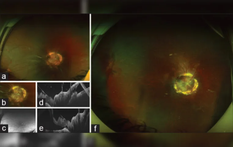 Outcomes of vitreoretinal surgery in retinal detachment associated with morning glory disc anomaly Outcomes of vitreoretinal surgery in retinal detachment associated with morning glory disc anomaly