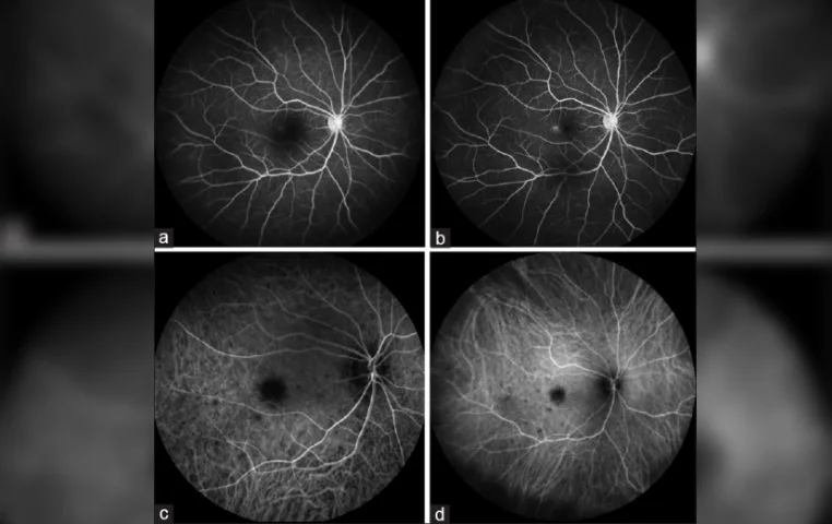 Presumed tubercular choroidal nodule following adalimumab therapy for juvenile idiopathic arthritis
