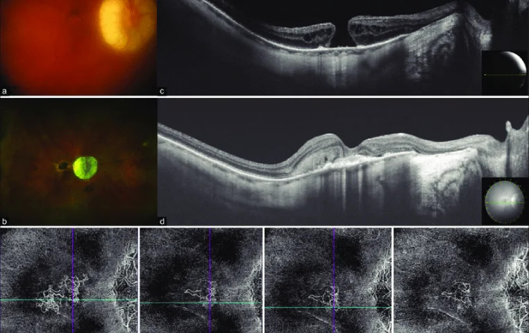Spontaneous closure of macular hole with conversion to type 2 Spontaneous closure of macular hole with conversion to type 2